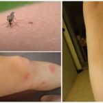 Picada de picada de mosquito