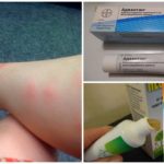 Remédios para picadas de mosquito
