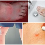 Ações para picadas de mosquito empolando