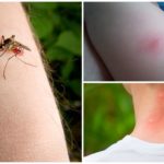 Picada de mosquito