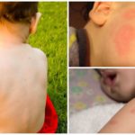 Picadas de mosquito em crianças