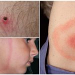 Os primeiros sinais de borreliose