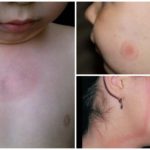 Borreliose em crianças