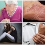 Sintomas do estágio crônico de borreliose