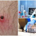 Exame de sangue para borreliose