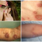 Borreliose transmitida por carrapatos