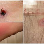 Mordida de encefalite no corpo humano