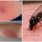 Mordida de mosca