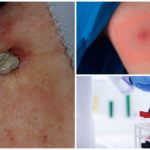 Exame de sangue após picada de carrapato