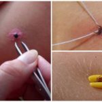 Métodos de extração de carrapatos