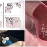 Enterobiose swab