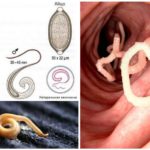 Pinworms
