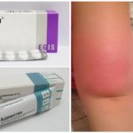 Preparativos para o tratamento de alergias a picadas de mosquito