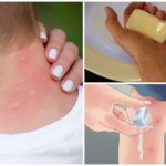 Tratamento de mordida de mosquito