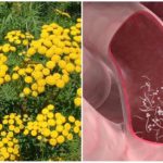 Tansy com enterobíase