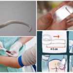 Diagnóstico de enterobíase