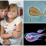 Giardia em uma criança